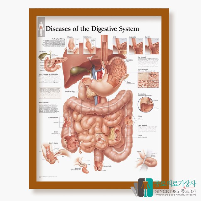 3B Scientific 천식 인체해부차트 VR1328 Asthma 천식차트 병원액자_액자추가